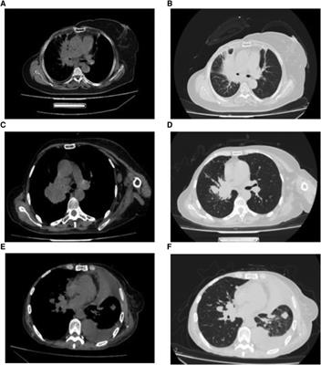Case report: Hilar metastasis of breast cancer: A single-center retrospective case-control study